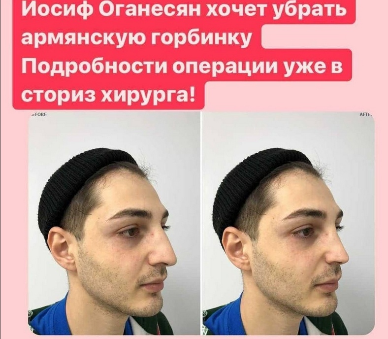 Иосиф Оганесян хочет сделать ринопластику